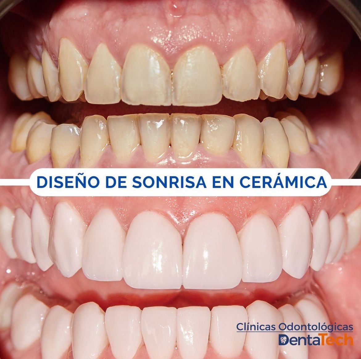 diseño de sonrisa en ceramica dentatech