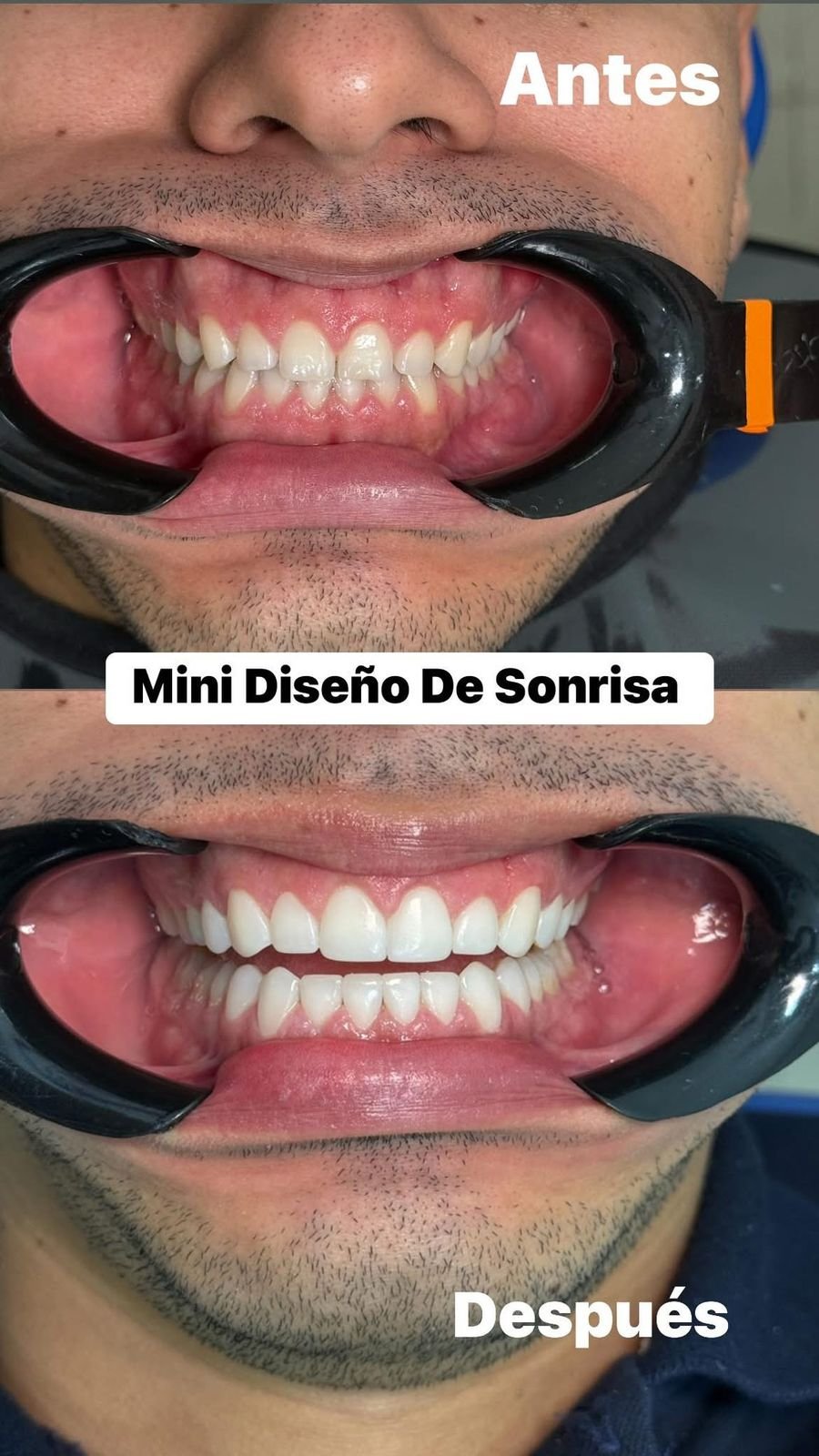 mini diseño de sonrisa